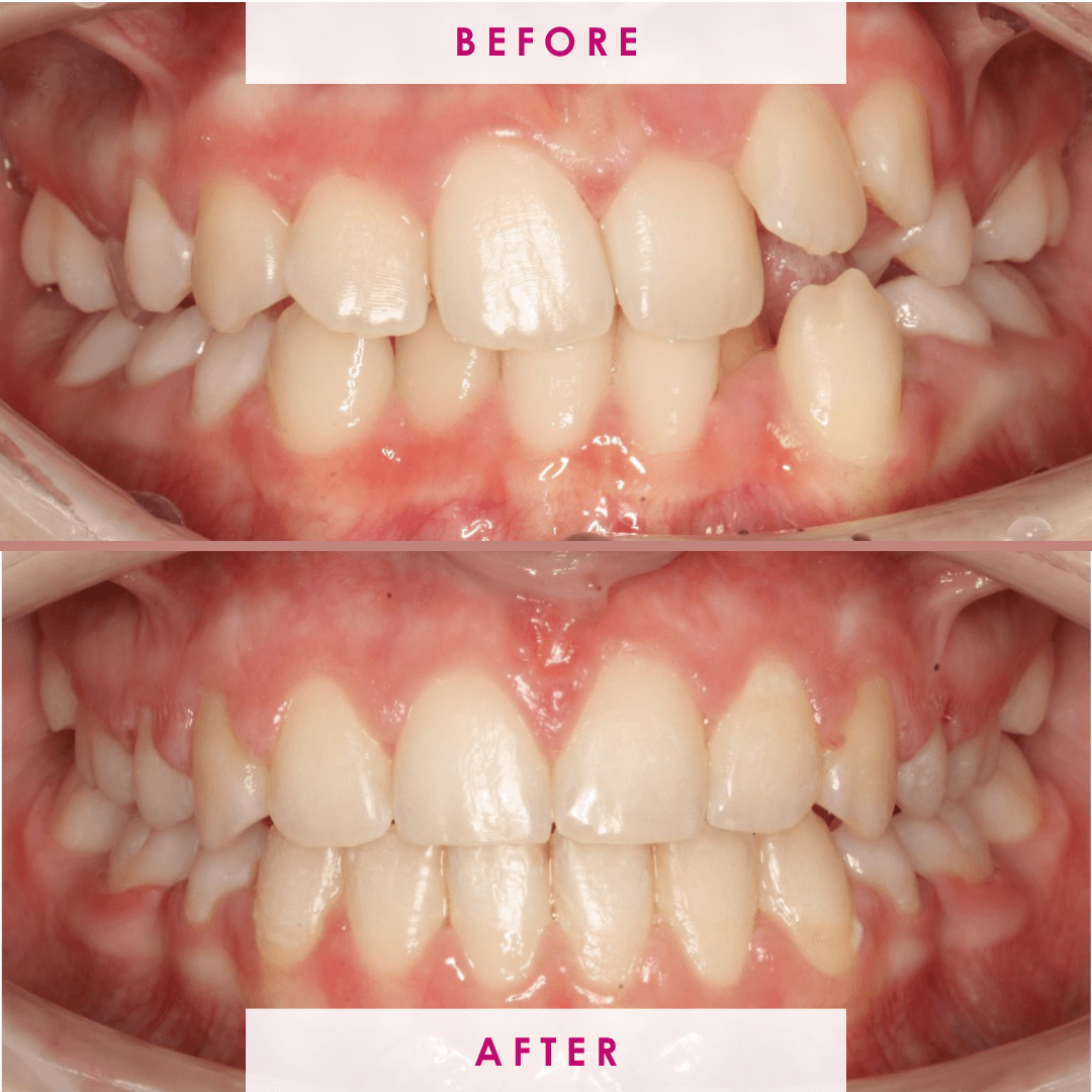 Before and after  (1)