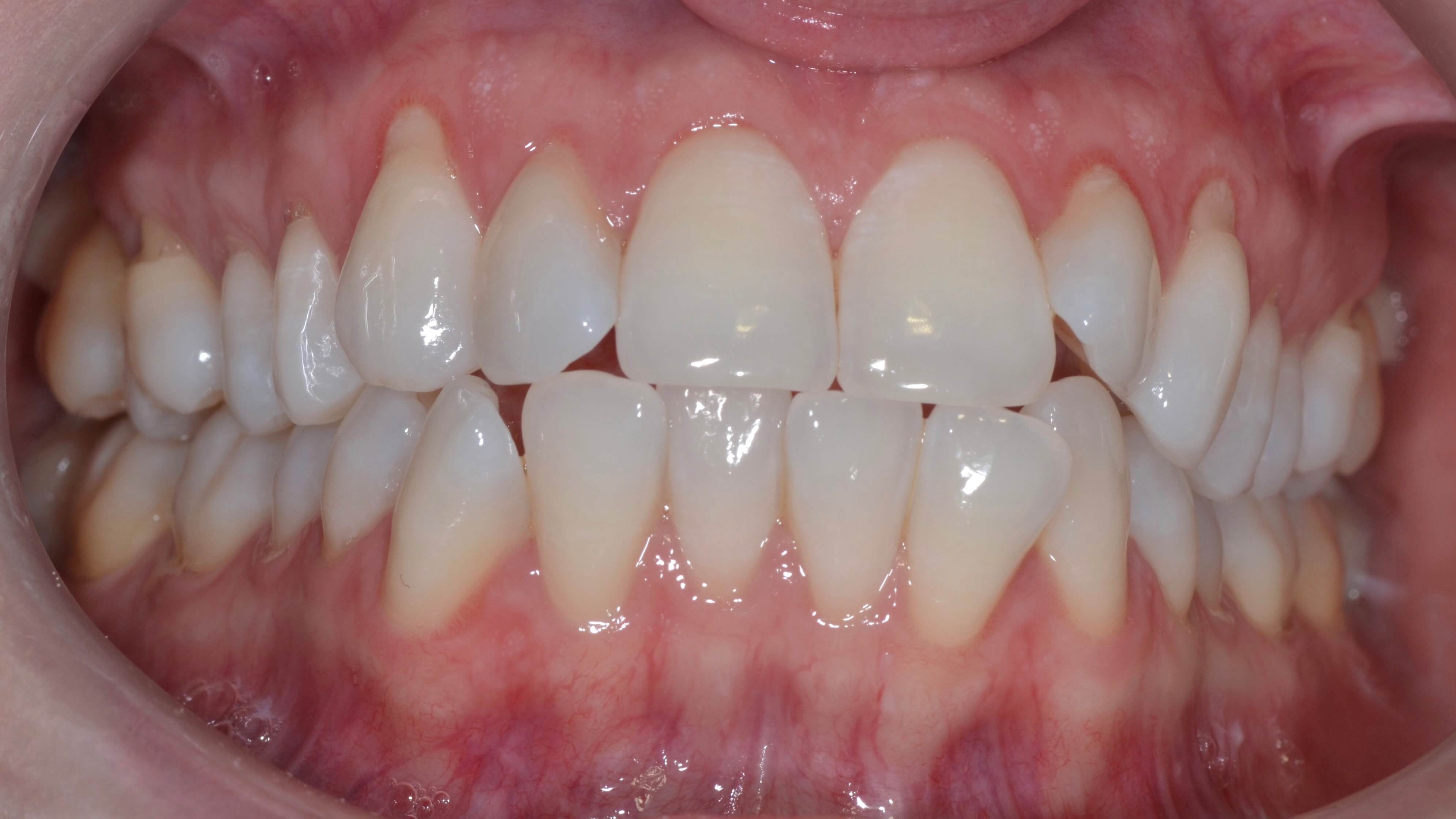 Ceramic braces Nottingham