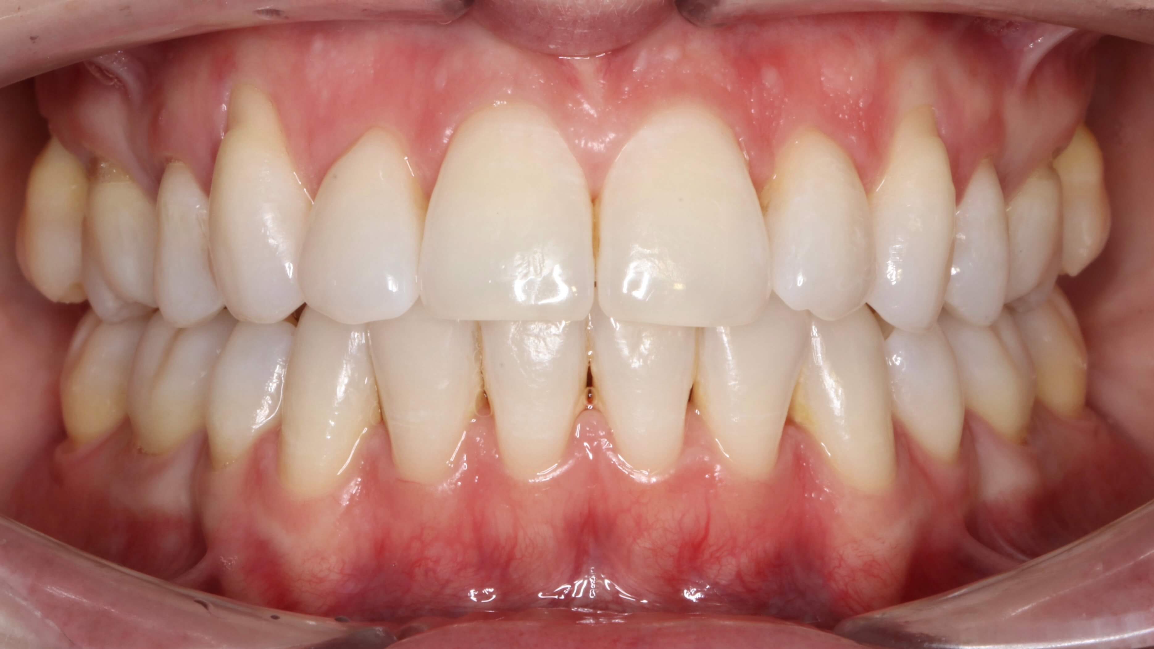 Ceramic braces Nottingham