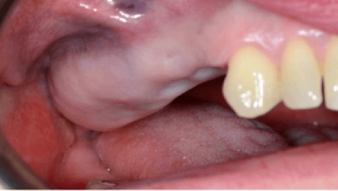 Dental-Implants-and-Bridge-Before