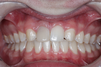 Front tooth composite after