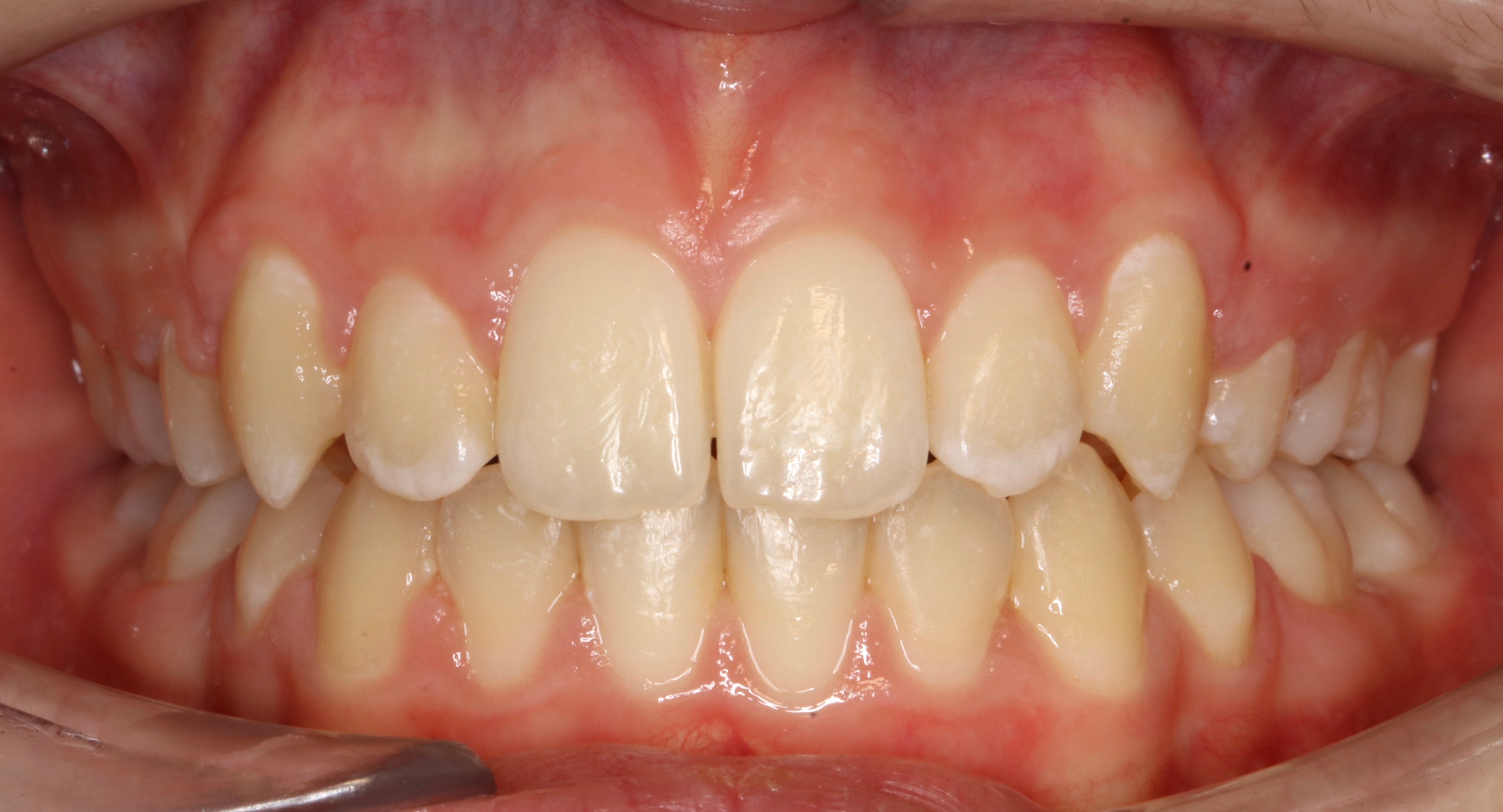 Fixed braces Nottingham