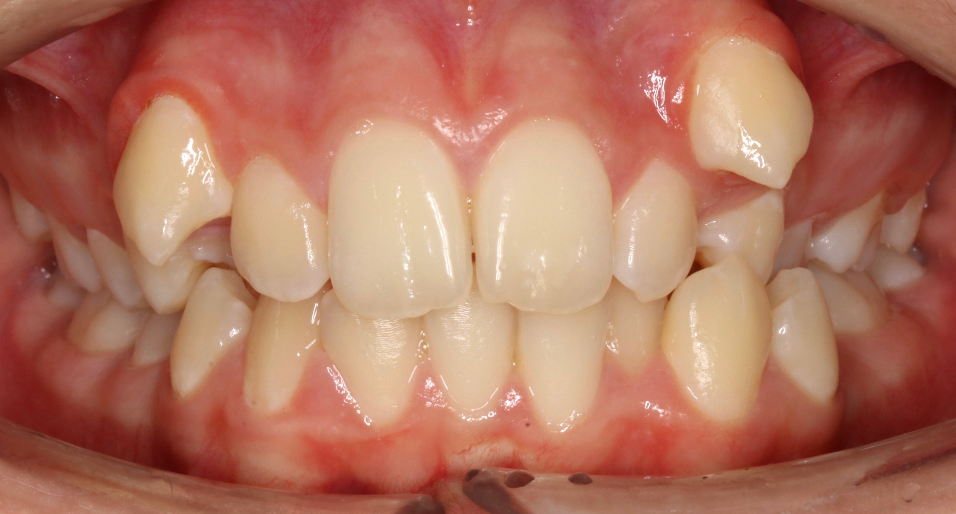 Fixed braces Nottingham