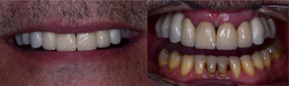 Replace-Partial-Denture-with-Implants-2