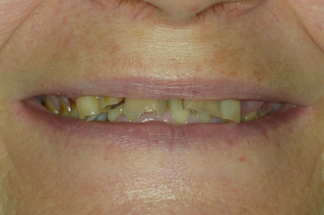 Before full arch treatment