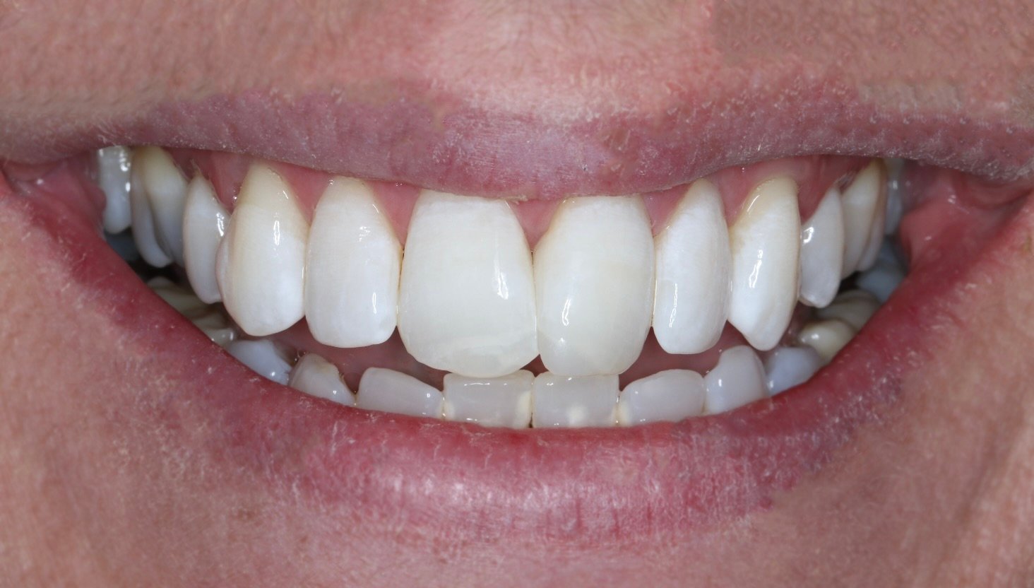 Teeth Whitening Nottingham 