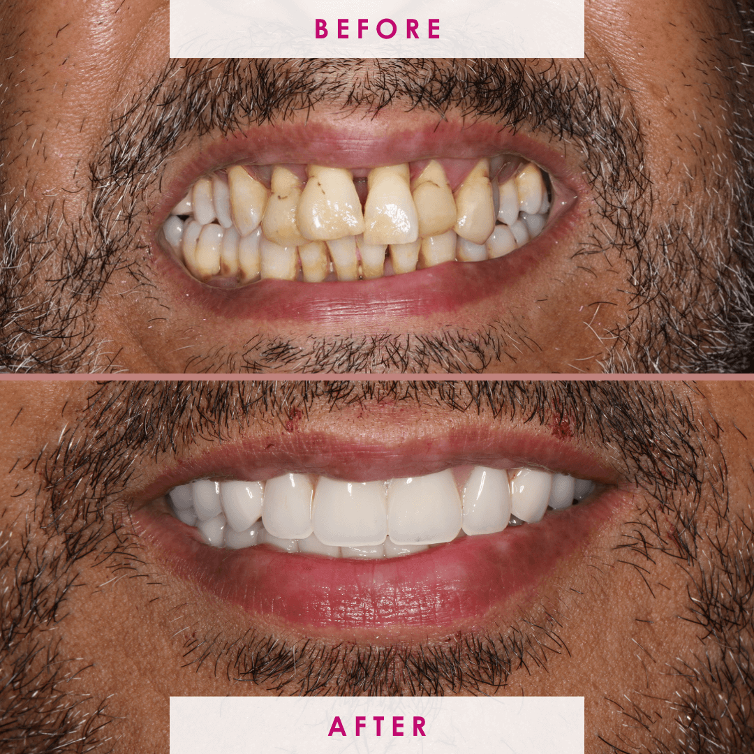 Dental implant before and after result at The Campbell Clinic